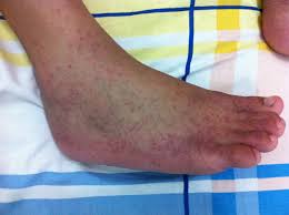 Picture of zika rash on foot