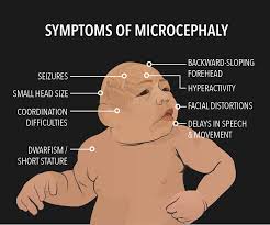 zika baby - microencephaly